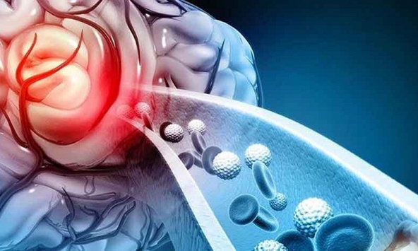 Đột phá liệu pháp nano giúp giảm tổn thương não sau đột quỵ