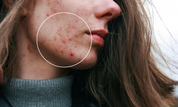 Công nghệ miếng dán vi kim mở hướng mới trong điều trị mụn trứng cá