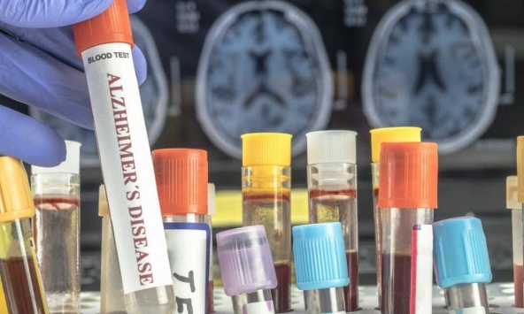 Chỉ xét nghiệm máu đơn giản cũng có thể dự đoán nguy cơ sa sút trí tuệ ở phụ nữ trước hàng chục năm