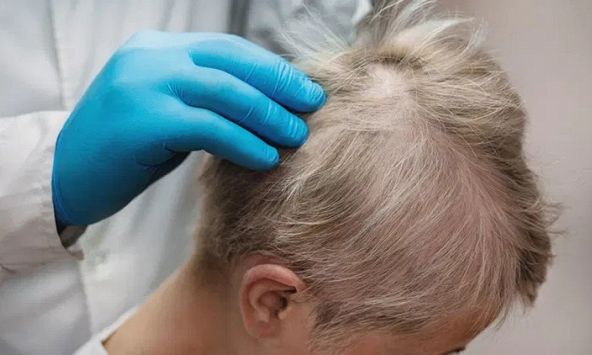 Bất ngờ tiềm năng chữa rụng tóc của thuốc trị viêm khớp 