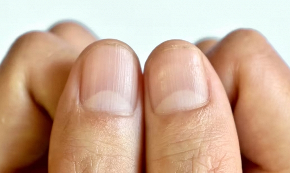 Dấu hiệu trên móng tay có thể báo hiệu bệnh lý tiềm ẩn
