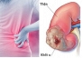Ung thư thận: Nhận diện sớm để tăng cơ hội điều trị hiệu quả