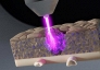 Tia plasma lạnh, 'vũ khí mới' trong điều trị ung thư: diệt khối u ẩn, giảm nguy cơ tái phát