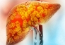 Vitamin B3, 'chìa khóa' trong điều trị gan nhiễm mỡ
