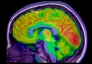 AI giúp nhận diện tổn thương não siêu nhỏ, tăng cơ hội điều trị động kinh ở trẻ em
