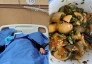 Một gia đình sáu người ăn trứng, 4 người bị ngộ độc và hai người nguy kịch phải chạy thận nhân tạo: Bác sĩ cảnh báo 'Đừng ăn kiểu này'